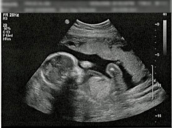 ultrasound