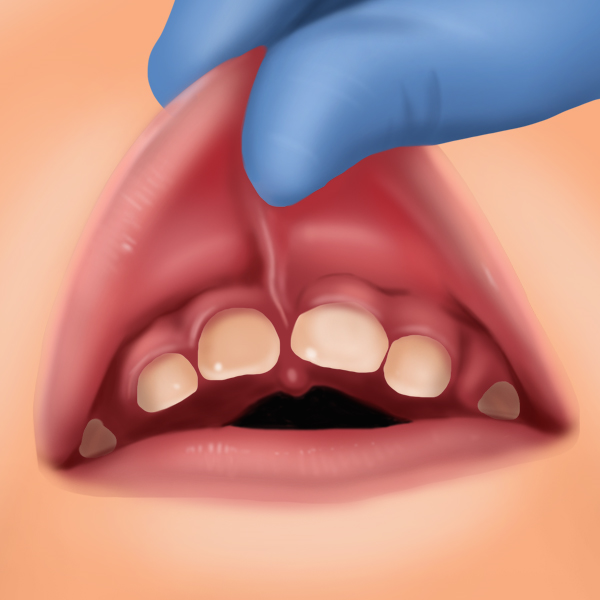 frenulectomy